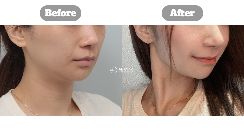 韓國AB皮膚科 Ulthera 音波拉提 200 發施術前後對比照片