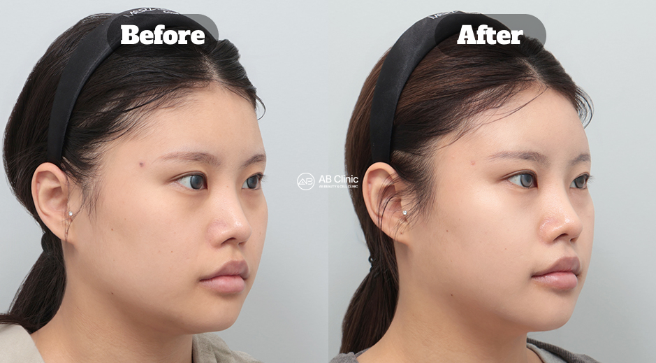 韓國AB皮膚科 音波拉提與麗珠蘭 真實前後側臉對比