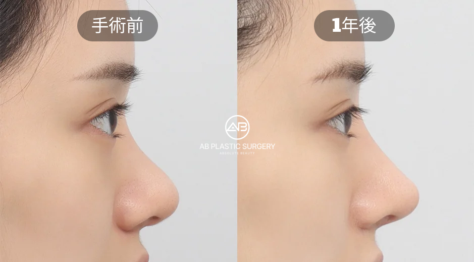 韓國AB整形外科案例：自然隆鼻與鼻修復手術前後對比