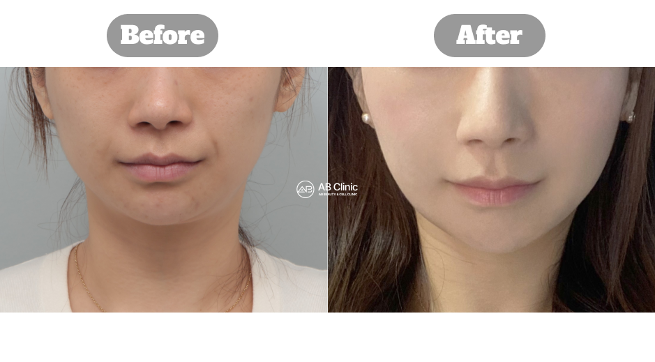 韓國AB整形外科美版音波拉提200發治療前後效果對比改善下顎線與輪廓線條