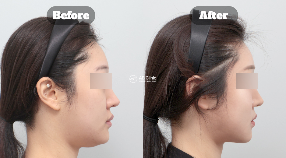 韓國AB整形外科美版音波拉提改善下顎線與臉部輪廓側臉前後效果對比