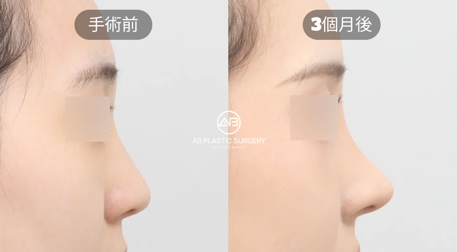 韓國AB整形外科隆鼻案例：自體軟骨隆鼻改善鼻頭比例術後三個月效果