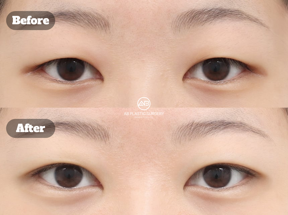 韓式雙眼皮手術打造丹鳳眼效果的術前術後眼型變化