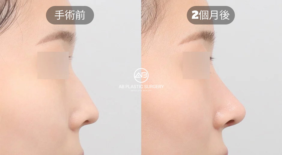 韓國AB整形外科自然隆鼻案例：鼻中隔矯正與鼻整形術後兩個月效果