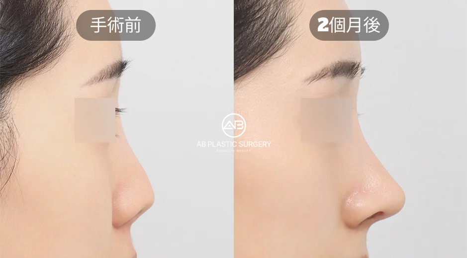 韓國AB整形外科案例：自體軟骨隆鼻合併短鼻修復術後兩個月效果