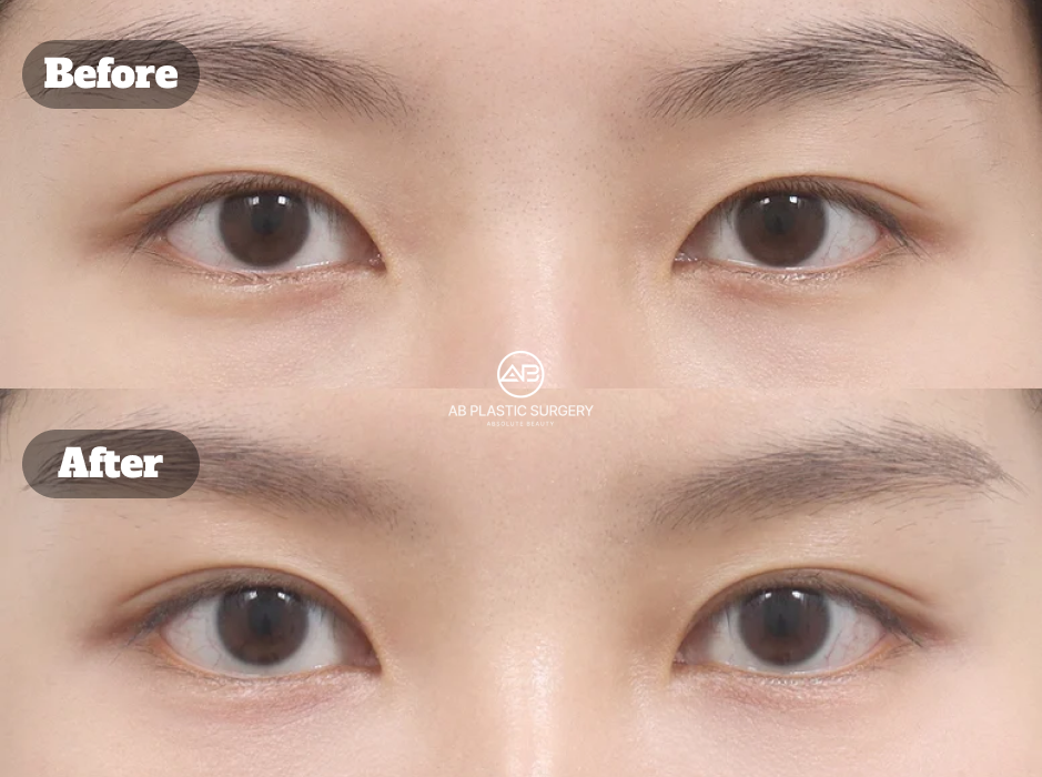 韓式眼整形透過雙眼皮與眼型設計優化丹鳳眼比例的術前術後比較