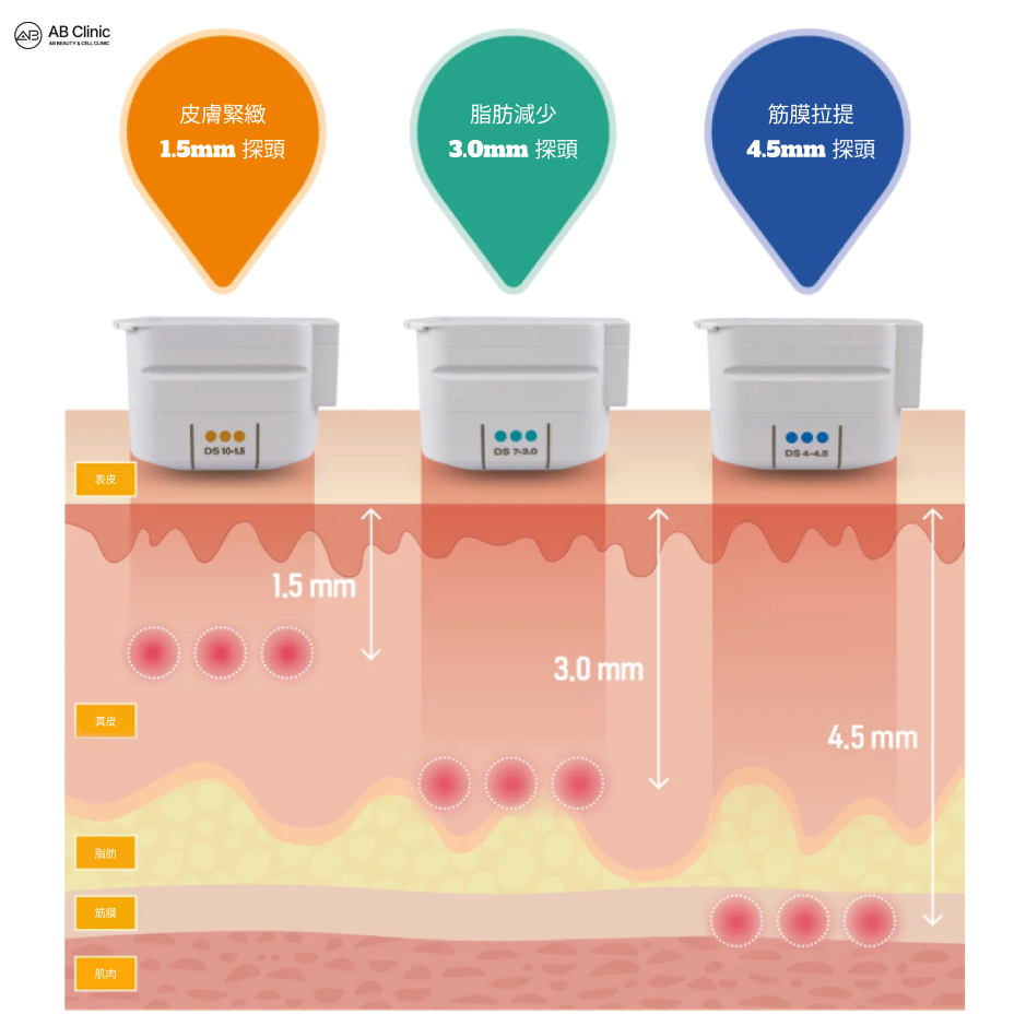 美版音波拉提（Ultherapy PRIME）透過1.5mm、3.0mm與4.5mm不同深度探頭分層作用於真皮與SMAS筋膜層示意圖
