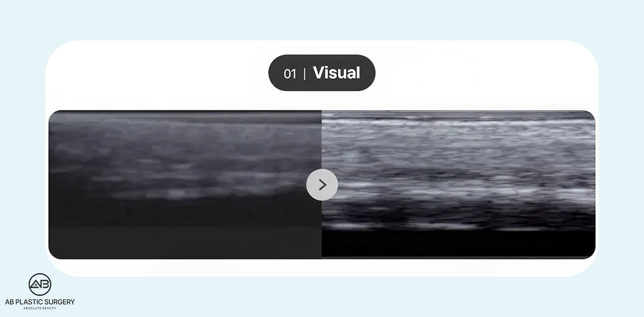 美版音波拉提（Ultherapy PRIME）透過即時超音波影像監測精準定位SMAS筋膜層示意圖