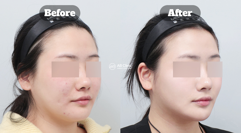 韓國AB整形外科美版音波拉提（Ultherapy）與鳳凰電波拉提前後效果對比改善下顎線與雙下巴輪廓