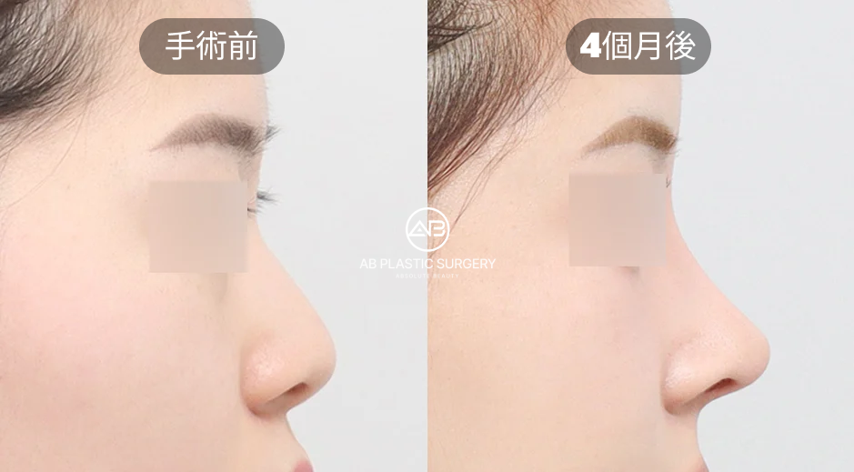 韓國AB整形外科案例：自體軟骨隆鼻合併功能鼻整形術後四個月效果