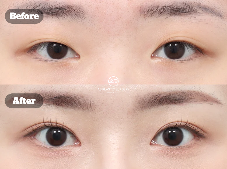 韓式眼型手術改善丹鳳眼眼尾弧度與眼神線條的術前術後對比