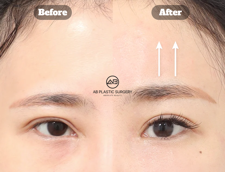 韓國AB整形外科內視鏡提眉與額頭拉提術前術後效果對比