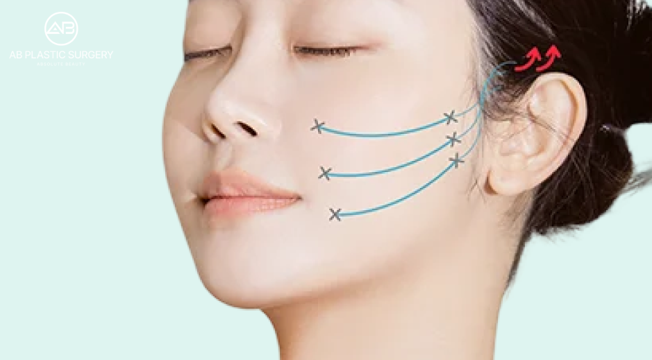 線雕療程透過PDO線材將下垂臉部向上拉提的原理解說