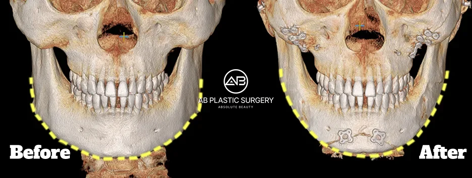 下顎角手術前後骨骼結構變化的3D影像對比示意圖