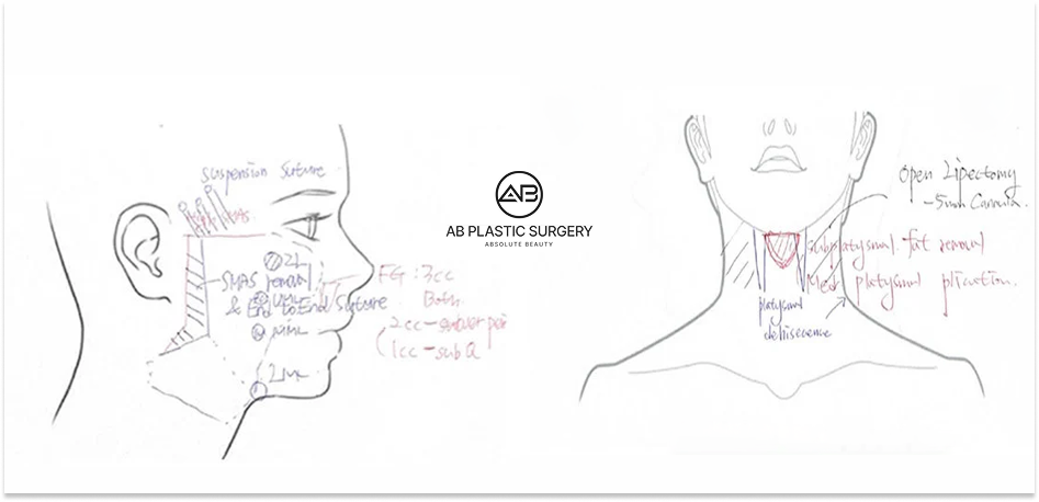 線雕療程前於AB整形外科進行臉部結構分析與拉提設計的諮詢筆記圖