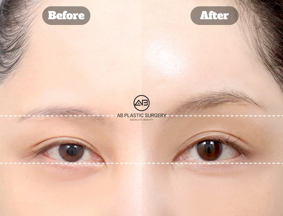 韓國AB整形外科內視鏡提眉與額頭拉提提升眼睛開放度術前術後比較