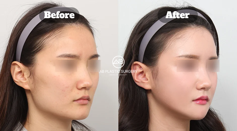 下顎角手術搭配顴骨與下巴整形術後3個月臉部輪廓改善的前後對比圖