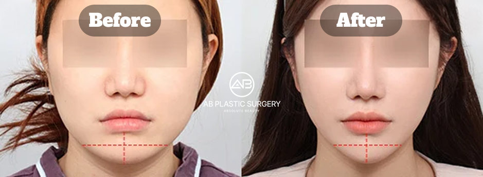 下顎角手術搭配顴骨與下巴整形及額頭拉提與脂肪移植術後9個月臉部輪廓變化對比圖