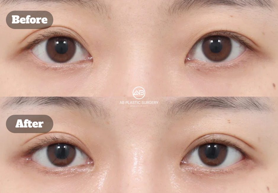 透過非切開眼瞼矯正結合後眼角下眼瞼與眉提升手術改善大小眼術後2個月前後對比圖