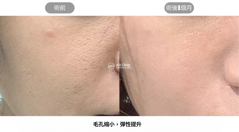 Potenza黃金微針毛孔緊緻與肌膚彈力提升案例