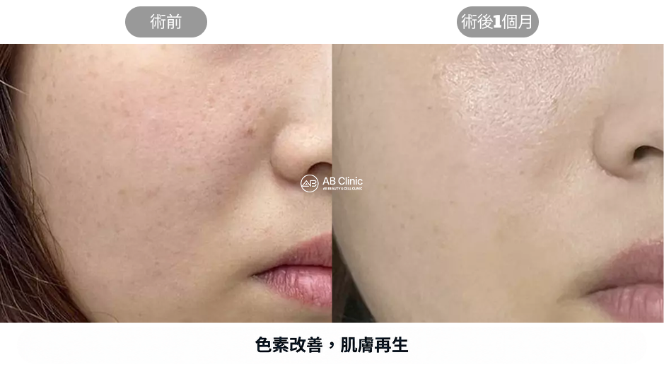 Potenza黃金微針淡化色斑與促進肌膚更新案例