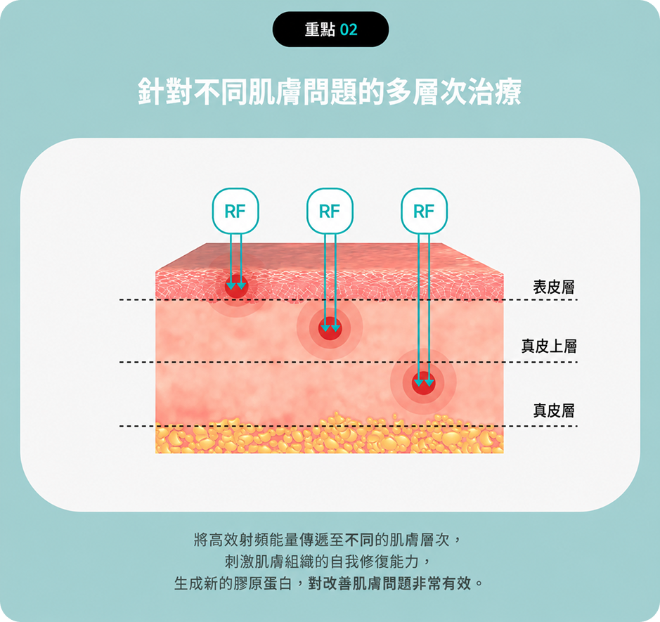 Potenza黃金微針依不同皮膚層次進行RF能量治療