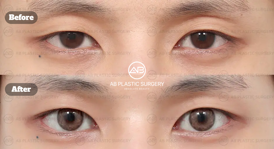 韓國AB整形外科男性眼部整形前後對比照，呈現術後眼睛開放感與自然眼型的變化。