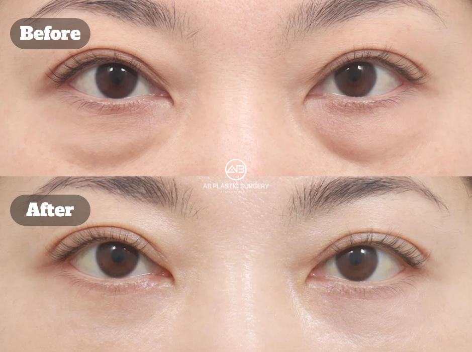 韓國AB整形外科眼袋手術案例，下眼瞼手術前與術後1個月的眼袋及眼下輪廓對比。
