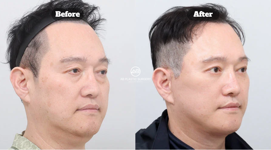 韓國AB整形外科男性拉提術後1個月案例，包含全臉拉提、頸部拉提、法令紋脂肪移植、下眼瞼與眉毛拉提的術前術後對比。