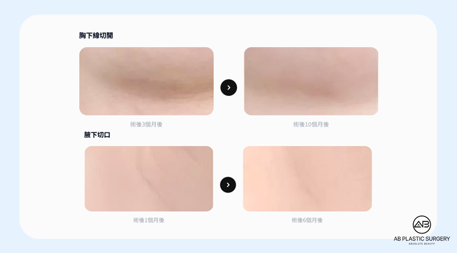 韓國AB整形外科隆胸切口疤痕恢復案例，比較乳房下緣切口與腋下切口在術後不同時期的疤痕變化。