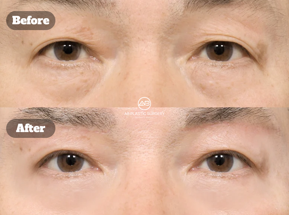 韓國AB整形外科眼袋手術前後案例，結合上眼瞼拉提、下眼瞼手術、雙眼皮埋線與眉下拉提，呈現眼周輪廓改善變化。