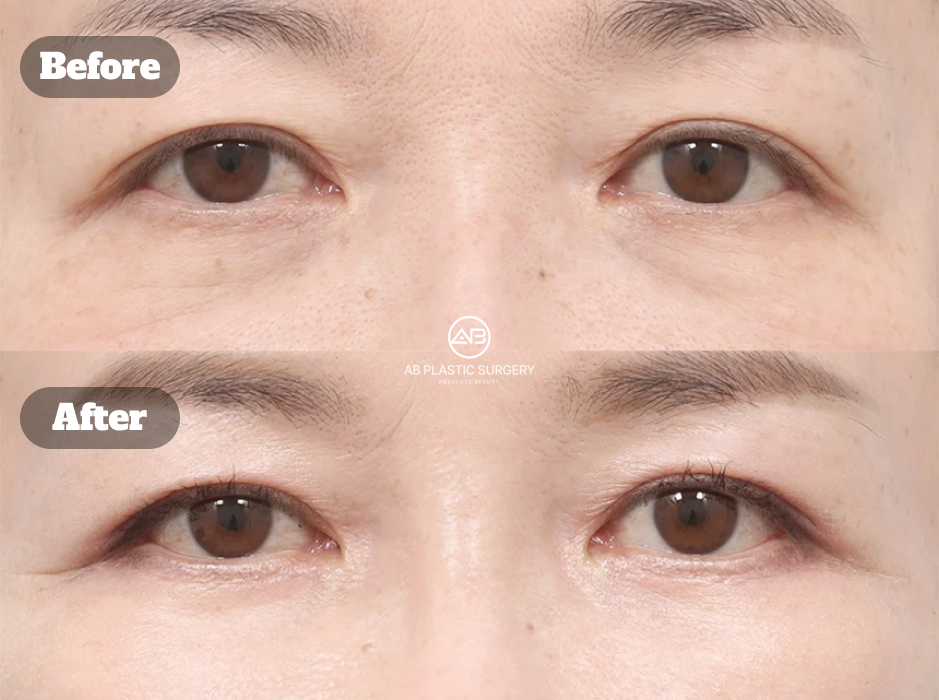 韓國AB整形外科眼袋手術前後案例，呈現下眼瞼手術前與術後2個月的眼袋、眼下鬆弛與輪廓變化。