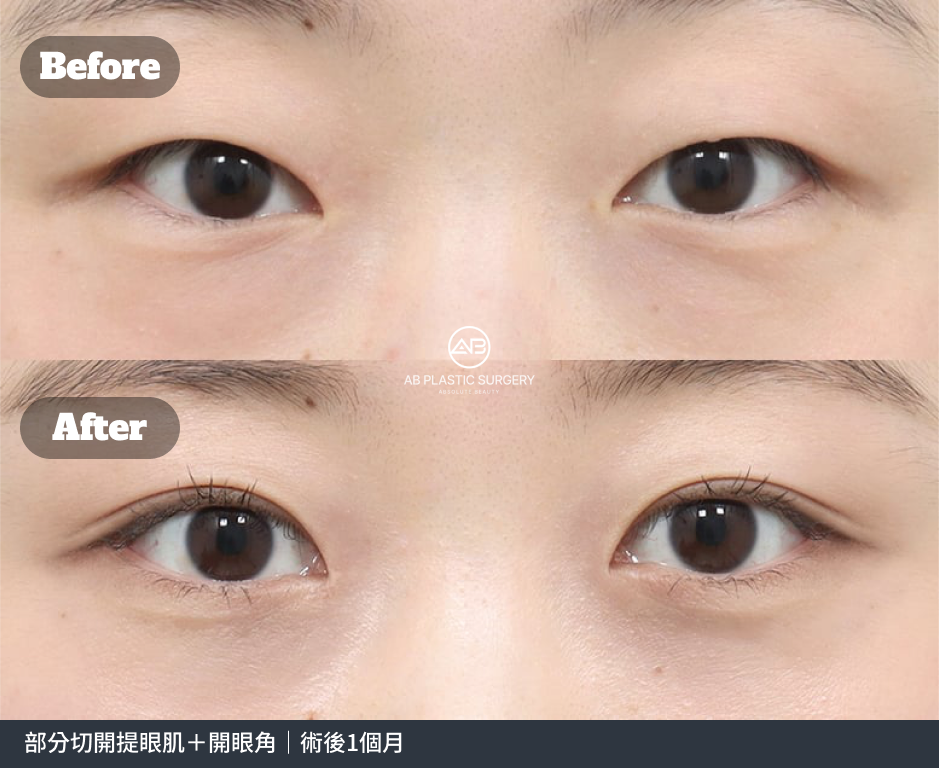 雙眼正面近照，上方標示Before，下方標示After；底部註明部分切開提眼肌合併開眼角，術後1個月。