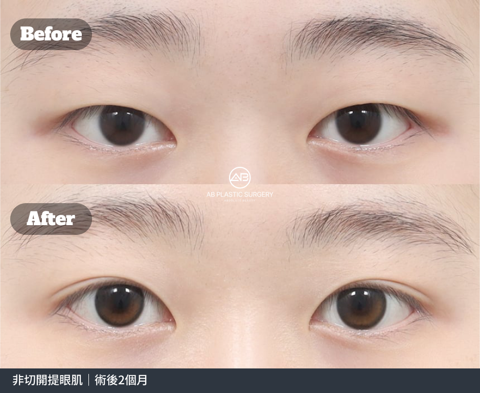 雙眼與眉毛的正面近照，上方為術前，下方為術後；底部註明非切開提眼肌，術後2個月。