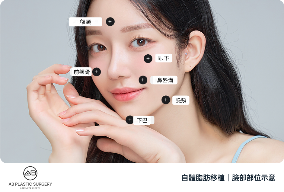 女性模特兒的斜角臉部照片上，以標記指出額頭、眼下、顴骨前側、鼻唇溝、臉頰與下巴等部位；這是部位示意，並非患者治療結果。
