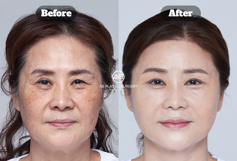 AB Plastic Surgery 美白、淡斑與拉提療程前後對照，正面膚色、斑點與臉部輪廓比較示意