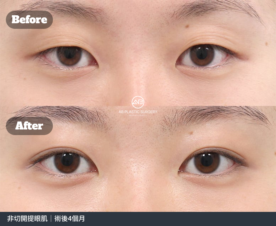 雙眼、眉毛與上眼瞼輪廓的正面對照，上方為術前，下方為術後；底部註明非切開提眼肌，術後4個月。