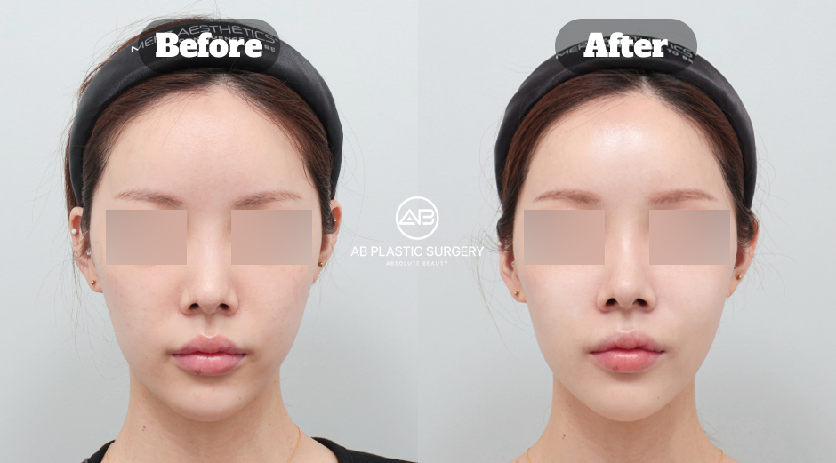 AB Plastic Surgery 麗珠蘭皮膚再生療程前後對照，正面膚質與臉部狀態比較示意