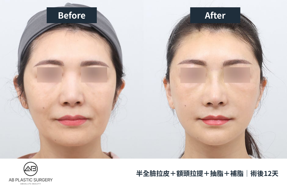 遮蔽雙眼的女性患者正面對照，左為術前，右為術後12天；案例包含半全臉拉皮、內視鏡額頭拉提、臉部抽脂與臉部脂肪移植。