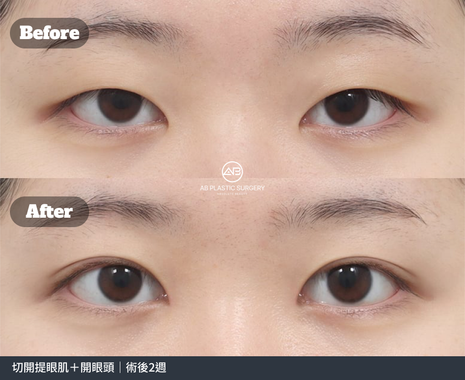 雙眼正面近照，上方為術前，下方為術後；底部註明切開提眼肌合併開眼頭，術後2週。