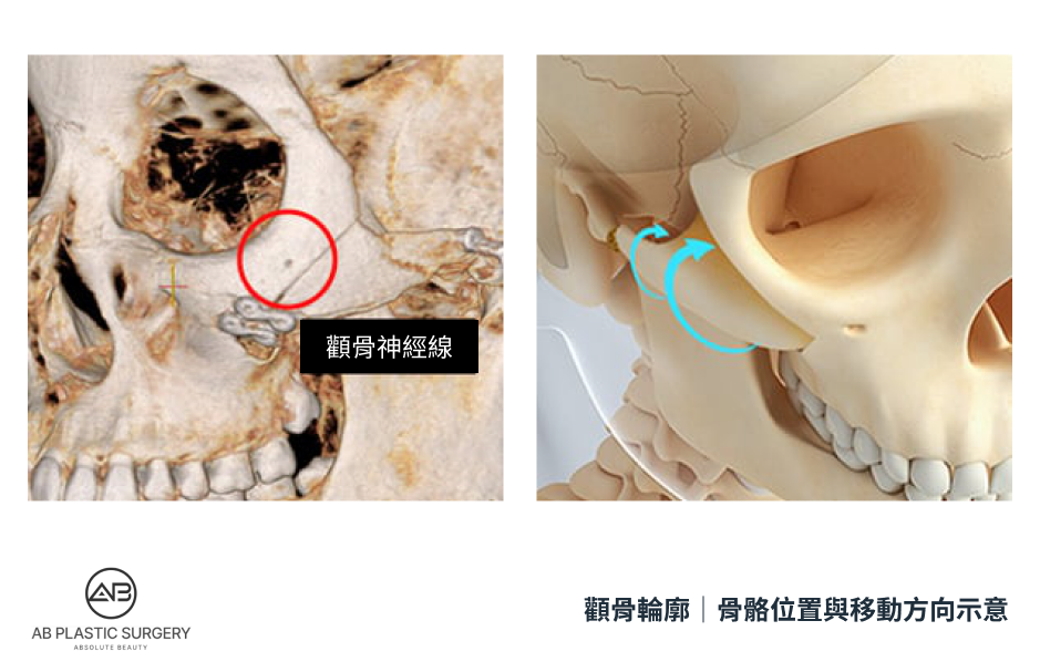 兩張頭骨影像並列，左圖以紅圈標示顴骨附近的神經線，右圖以藍色箭頭標示顴骨的移動方向；畫面用於說明解剖位置與手術概念。