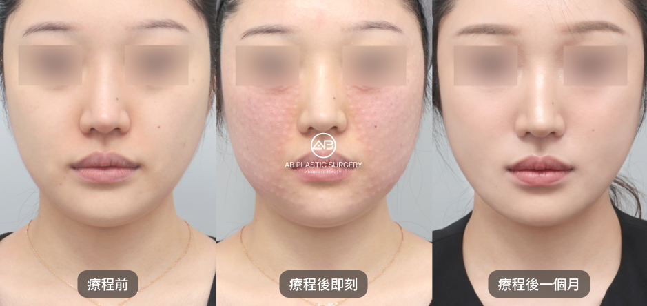 同一名女性的正面照片由左至右標示為療程前、療程後即刻及療程後一個月，眼部均已遮蔽。中間照片可見雙頰泛紅與多處小隆起，AB標誌位於整張畫面中央。照片為個別案例紀錄。