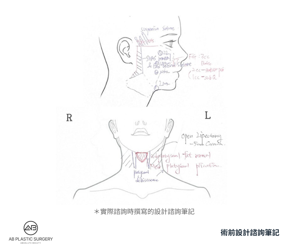 白色紙張上繪有臉部側面及頸部正面的線稿，旁邊附有手寫的評估與手術設計註記；底部標示為實際諮詢時撰寫的設計筆記。