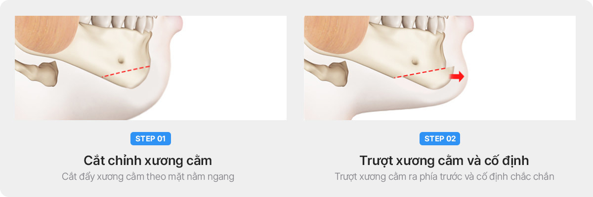 Phẫu thuật độn cằm silicon và phẫu thuật trượt cằm