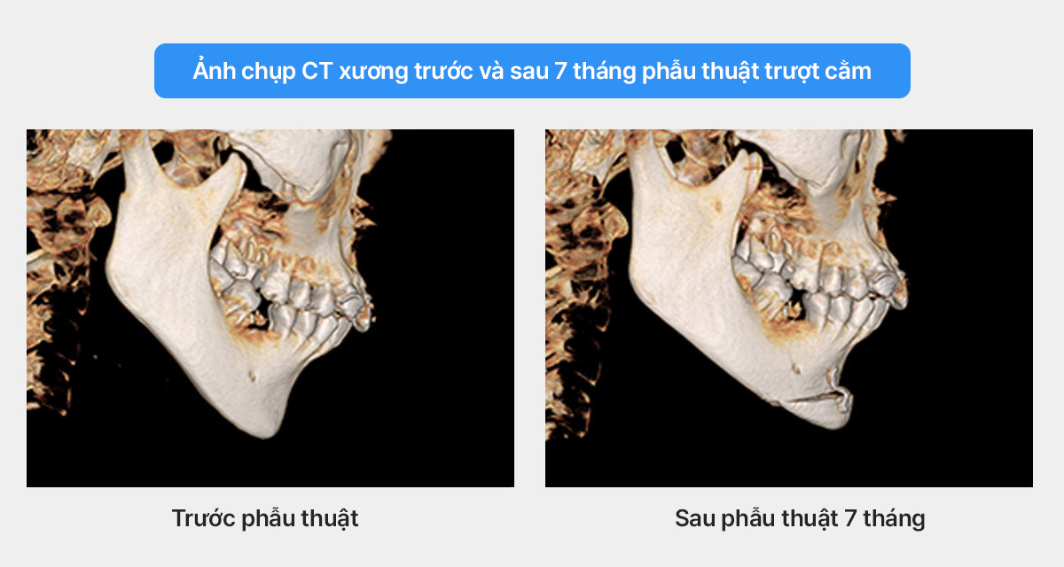 Bệnh nhân cằm lẹm nên chọn phương pháp phẫu thuật nào phù hợp nhất?