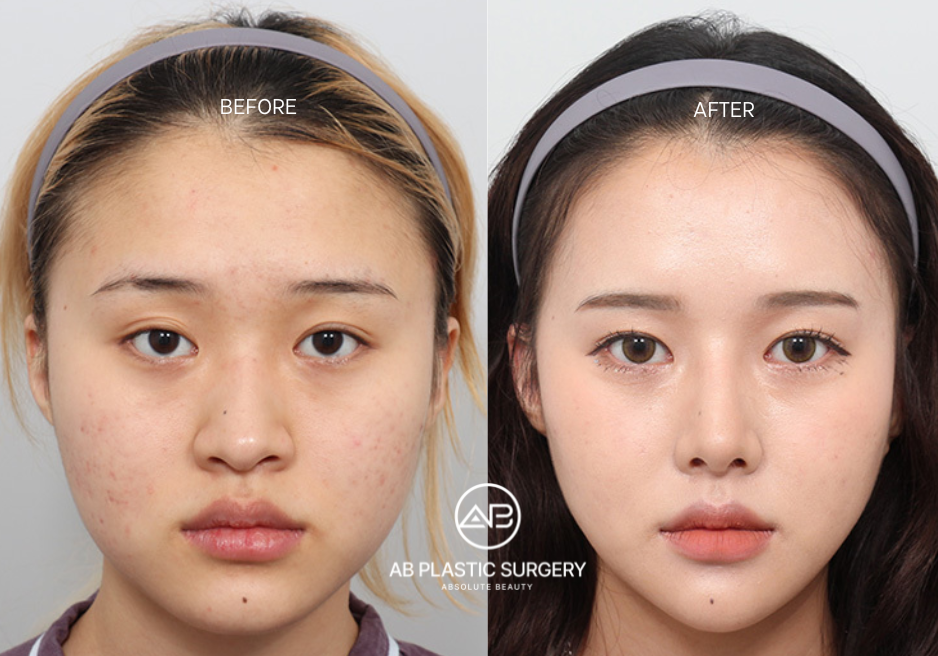 Tạo hình khuôn mặt tại Bệnh viện thẩm mỹ AB Hàn Quốc