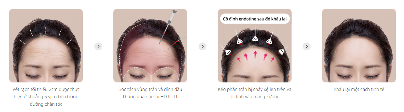 Nâng trán bằng cấy ghép Endotine