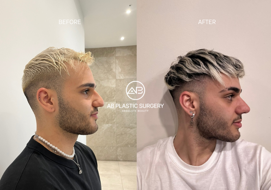 Phẫu thuật nâng mũi AB cho nam trước và sau