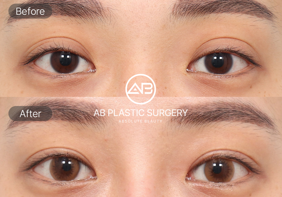 So sánh trước và sau phẫu thuật mắt Hàn Quốc