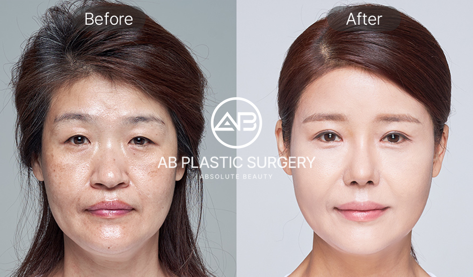 So sánh trước và sau điều trị chống lão hóa tại Hàn Quốc